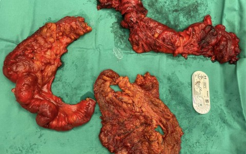 Ριζικό χειρουργείο για καρκίνο ωοθηκών