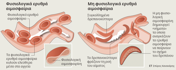 Σχεδιάγραμμα για την δρεπανοκυτταρική αναιμία
