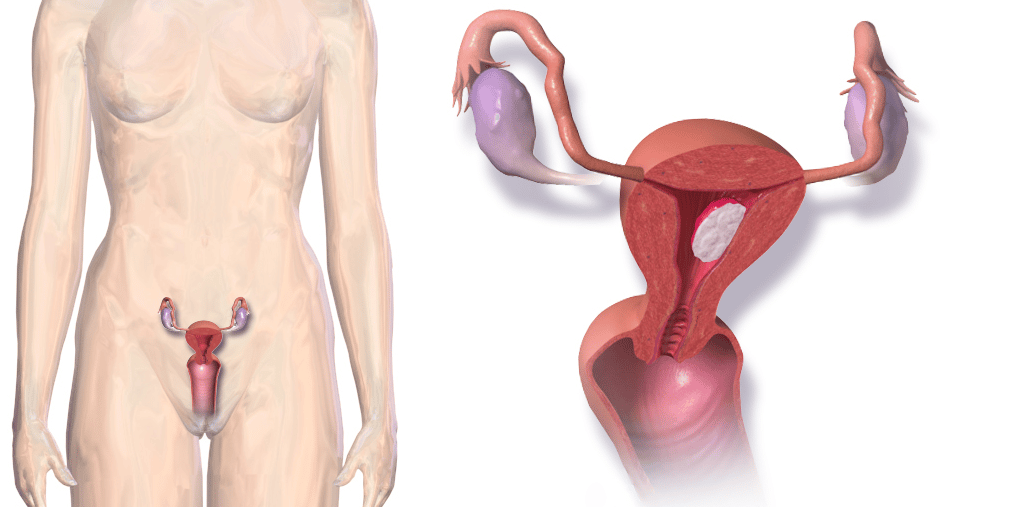 Ιατρικό σχεδιάγραμμα που δείχνει την ανατομία του καρκίνου του ενδομητρίου