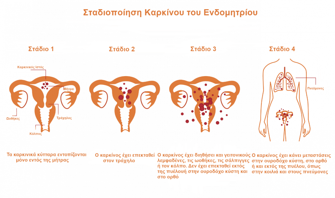 Σχεδιάγραμμα με τα στάδια του καρκίνου του ενδομητρίου