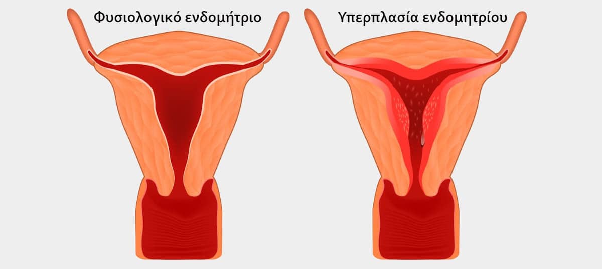 Σχηματική απεικόνισης για την υπερπλασία του ενδομητρίου