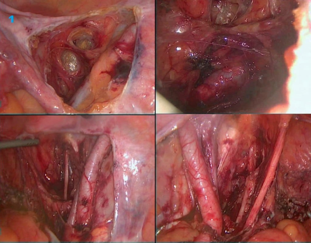 Hysterectomy 2