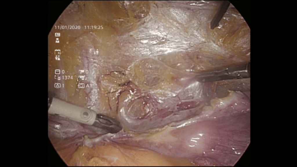 PARAMETRIAL DISSECTION