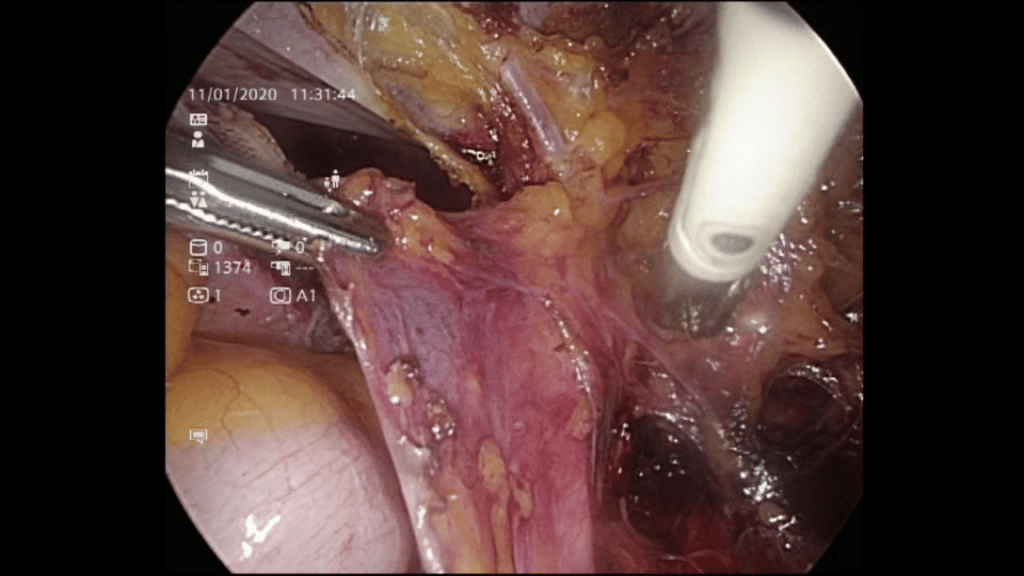 r ureteric dissection