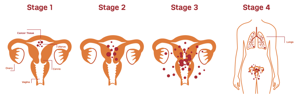 Γυναικολογικό μοντέλο με τα στάδια του καρκίνου του ενδομητρίου