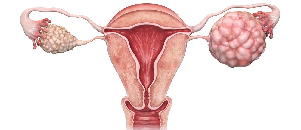 3d γυναικολογικό μοντέλο για τον καρκίνο ωοθηκών