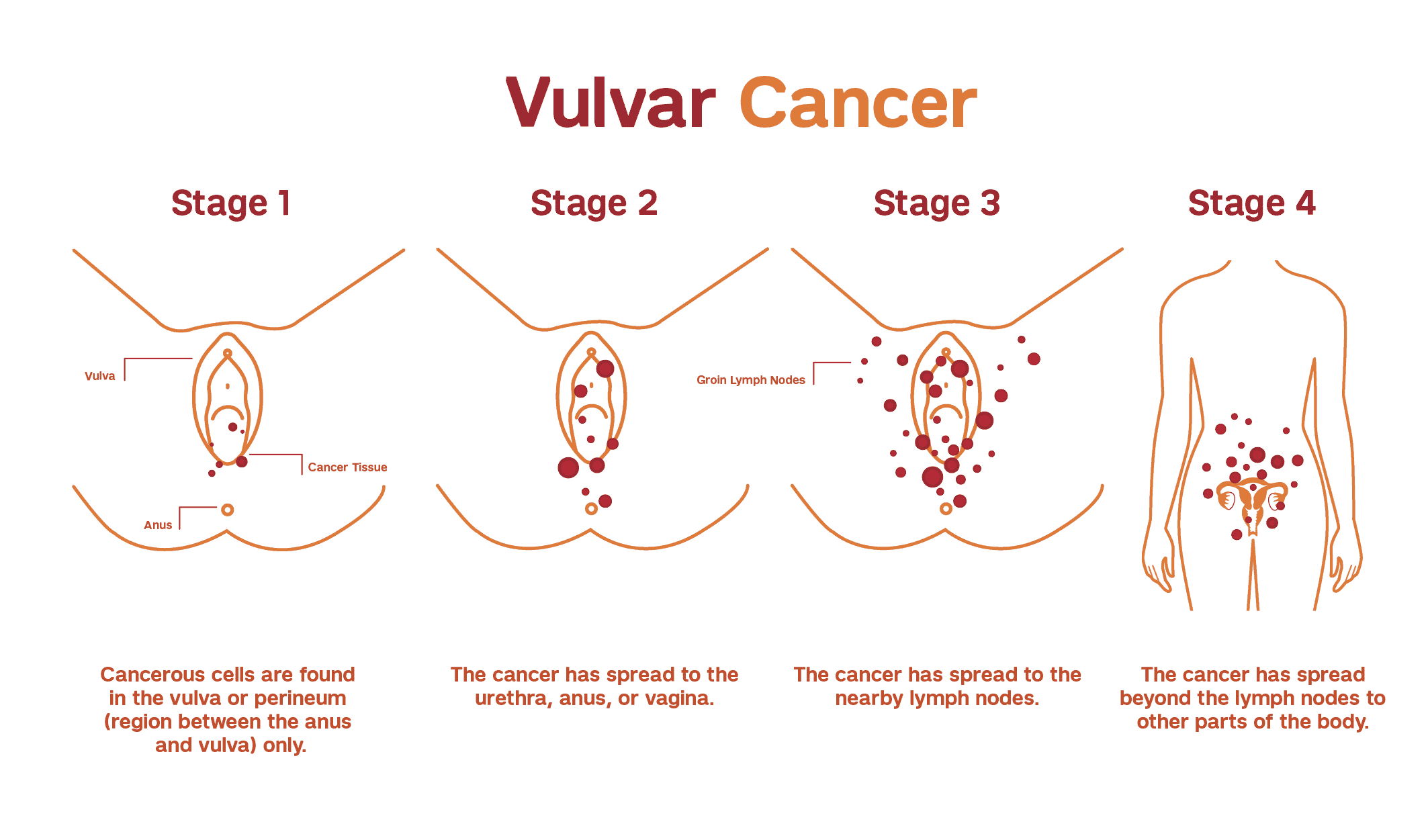 Στάδια καρκίνου του αιδοίου