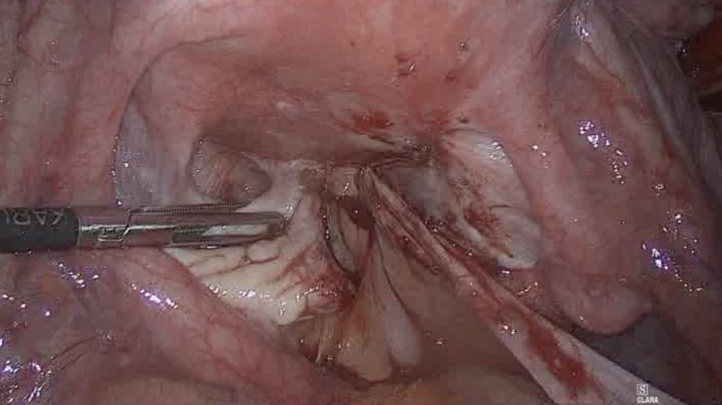 Λαπαροσκοπική υστερεκτομία σε ασθενή με ενδομητρίωση 1