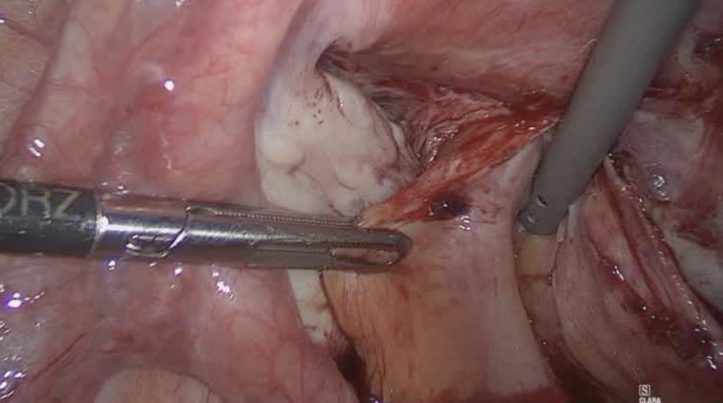 Λαπαροσκοπική υστερεκτομία σε ασθενή με ενδομητρίωση 2