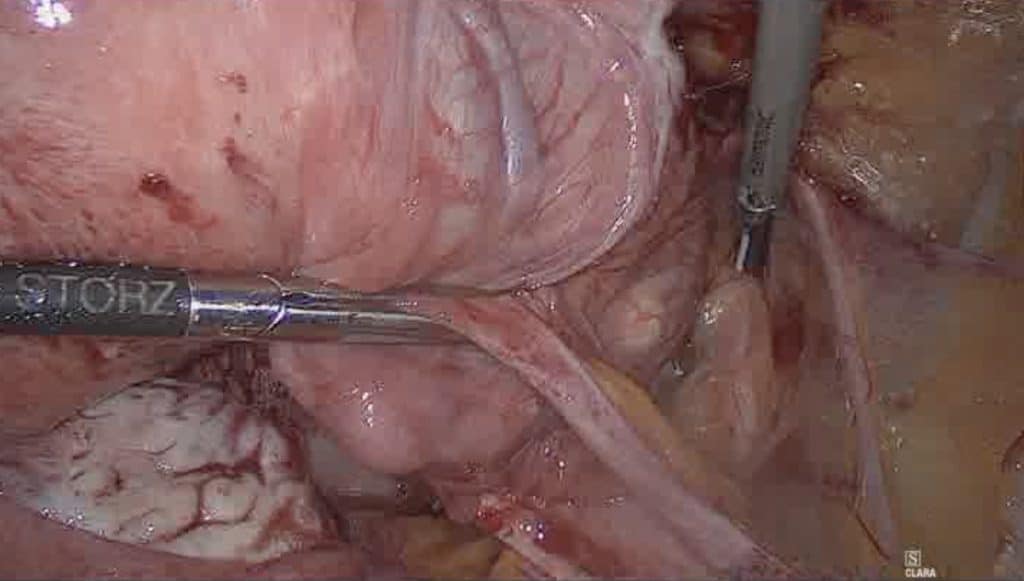 Λαπαροσκοπική υστερεκτομία σε ασθενή με ενδομητρίωση 3