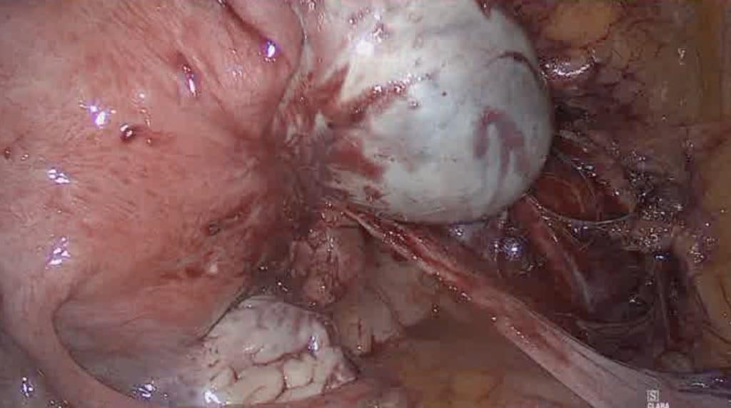 Λαπαροσκοπική υστερεκτομία σε ασθενή με ενδομητρίωση 4