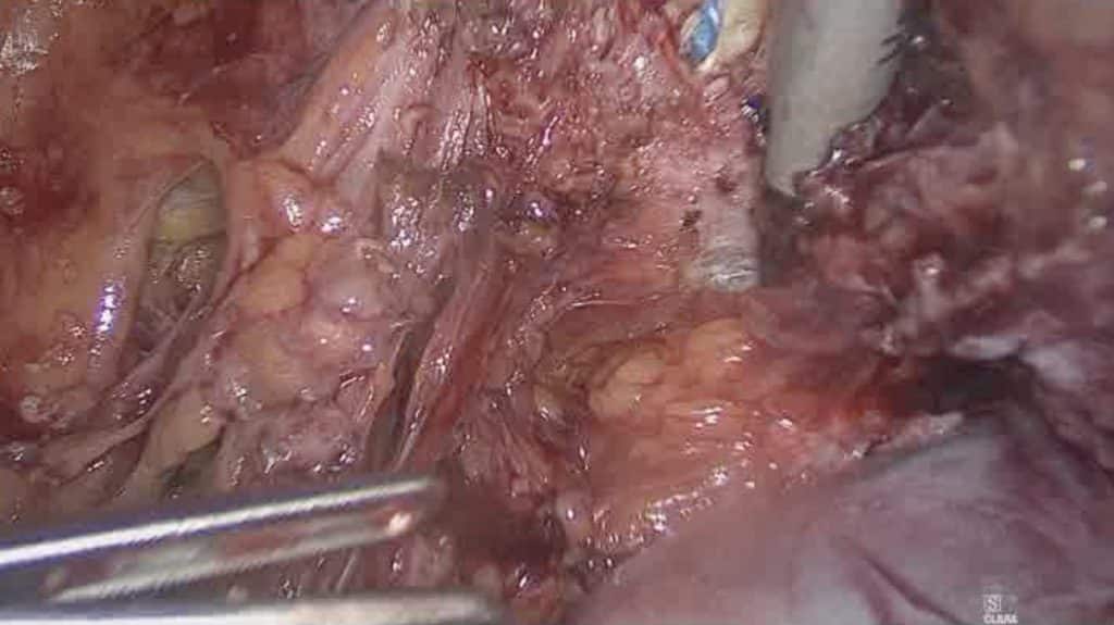Λαπαροσκοπική υστερεκτομία σε ασθενή με ενδομητρίωση 7