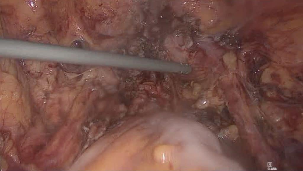 Λαπαροσκοπική υστερεκτομία σε ασθενή με ενδομητρίωση 8