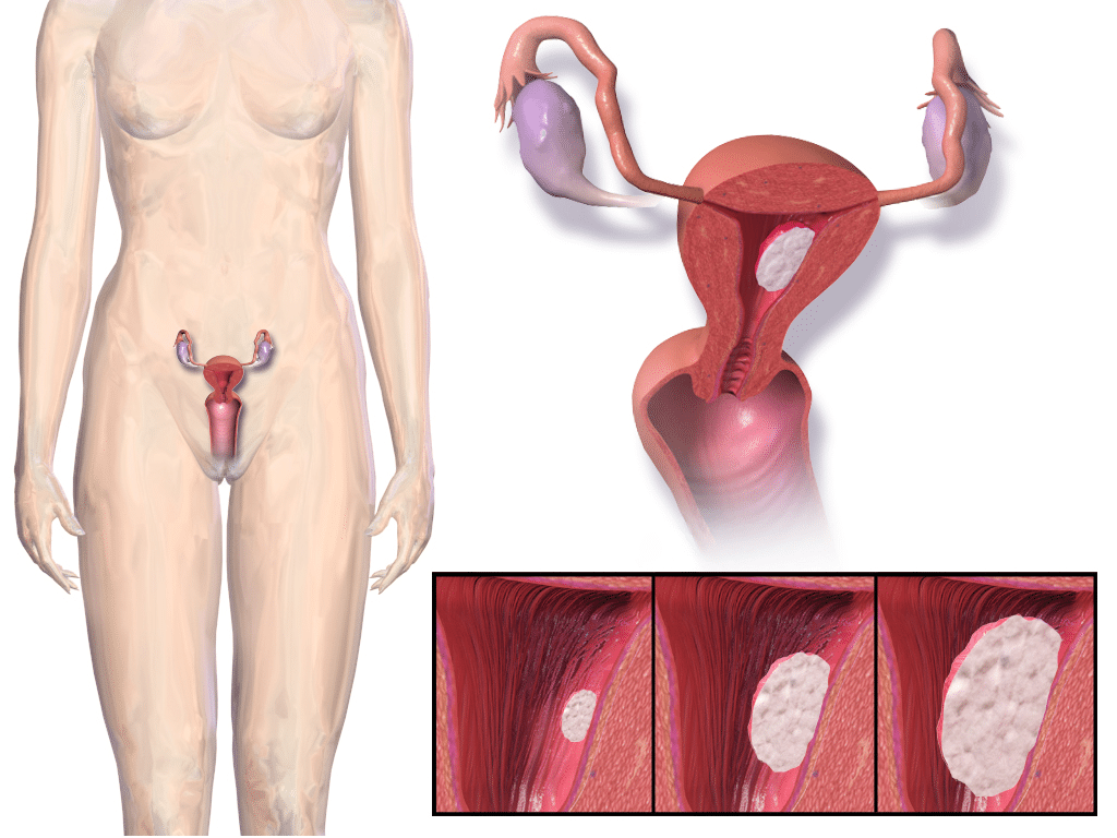 Ιατρική αναπαράσταση του καρκίνου του ενδομητρίου