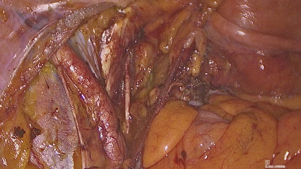 Αντιμετώπιση ορώδους καρκινώματος του ενδομητρίου