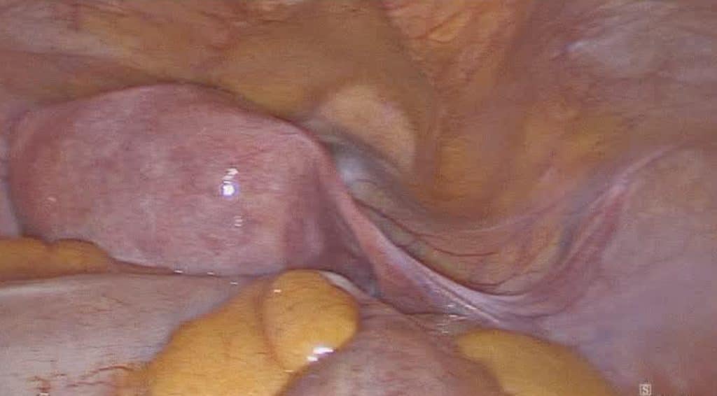 Λαπαροσκοπική αντιμετώπιση καρκίνου ενδομητρίου 2etopisi karkinou endomitriou με υστερεκτομία και αφαίρεση φρουρών λεμφαδένων 1