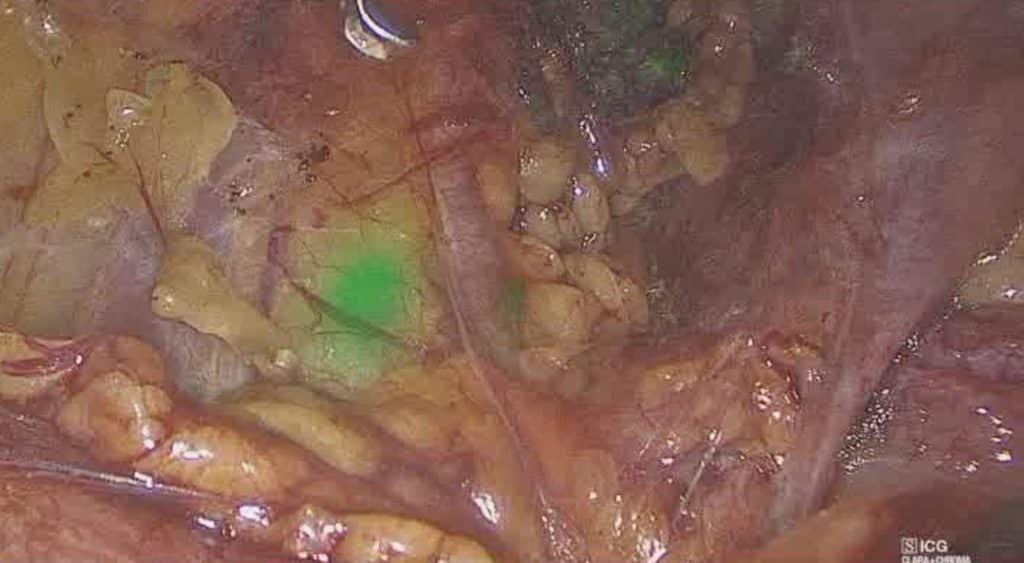 Λαπαροσκοπική αντιμετώπιση καρκίνου ενδομητρίου 2etopisi karkinou endomitriou με υστερεκτομία και αφαίρεση φρουρών λεμφαδένων 7