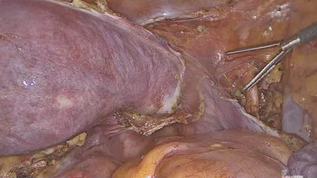 Λαπαροσκοπική αντιμετώπιση καρκίνου ενδομητρίου 2etopisi karkinou endomitriou με υστερεκτομία και αφαίρεση φρουρών λεμφαδένων 8