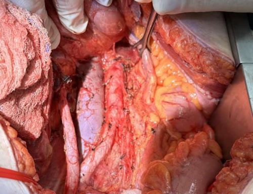Χειρουργική σταδιοποίηση για καρκίνο ωοθηκών από τον Μανόλη Καλαμπόκα