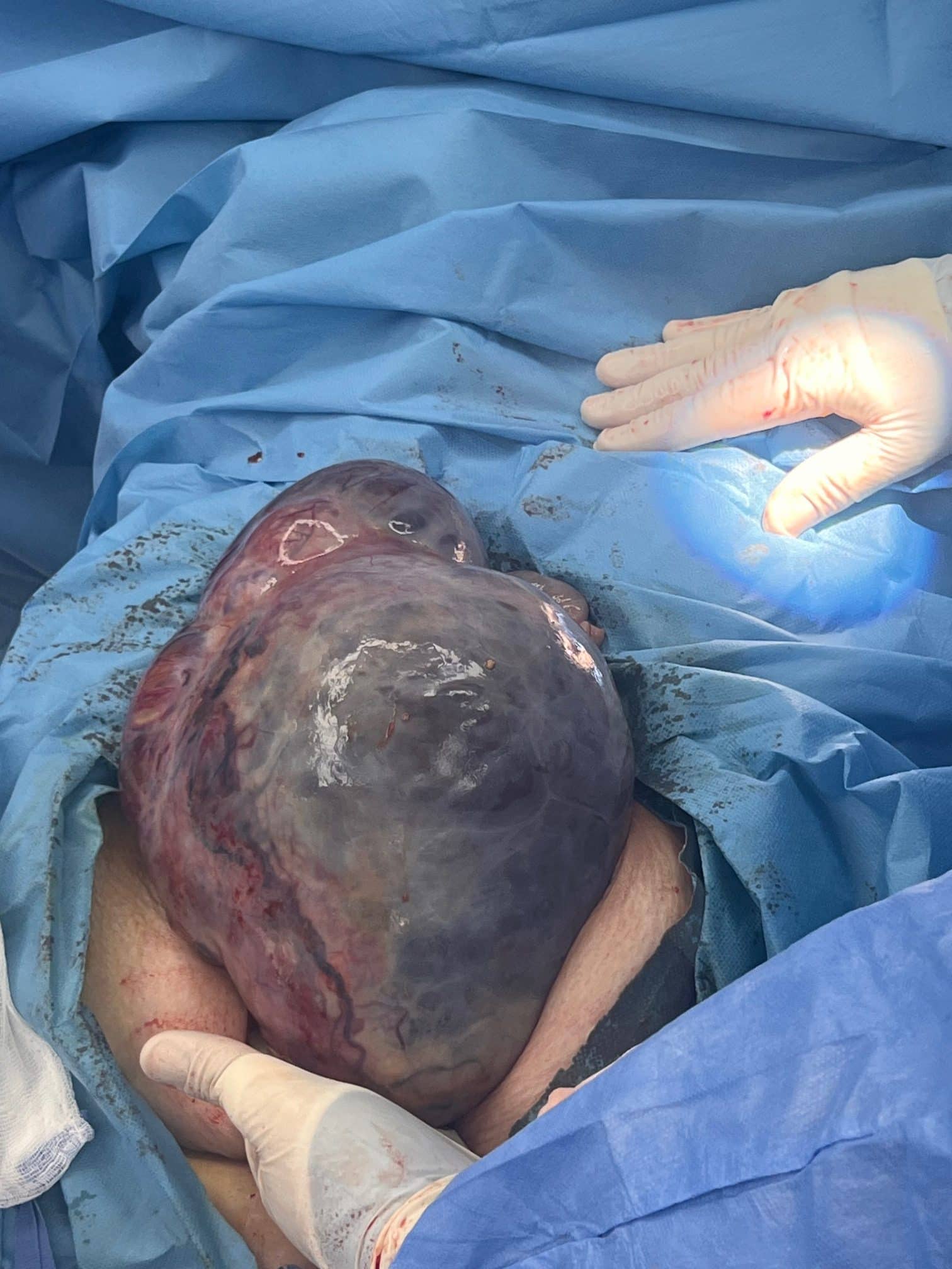 Ερευνητική λαπαροτομία και χειρουργική σταδιοποίηση για όγκο ωοθήκης