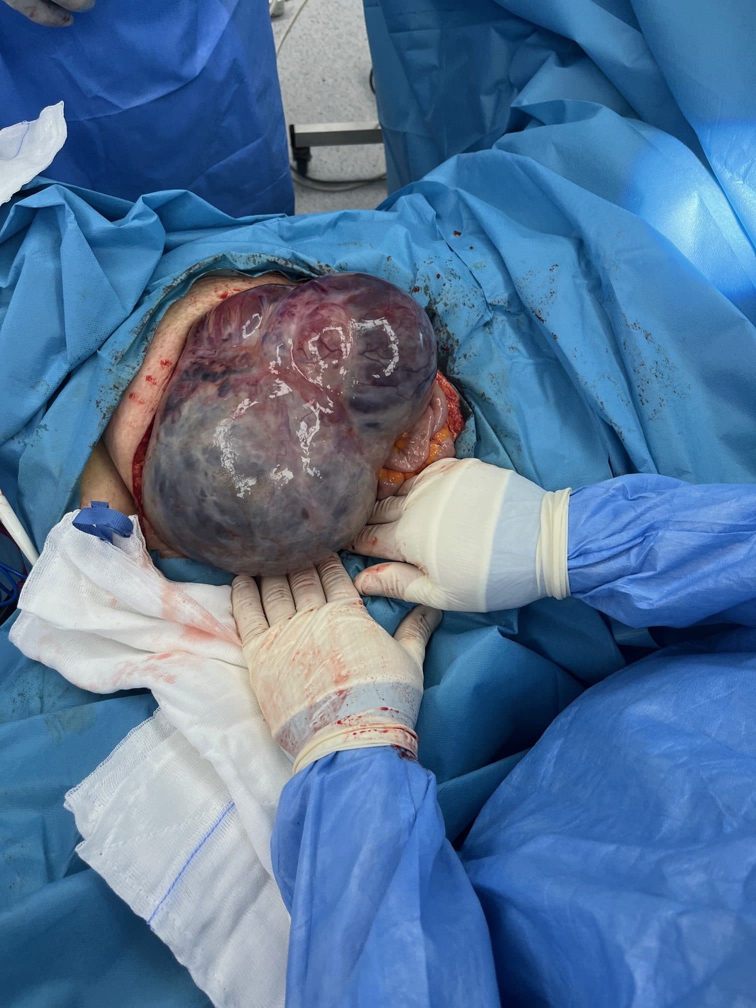 Ερευνητική λαπαροτομία και χειρουργική σταδιοποίηση για όγκο ωοθήκης 1